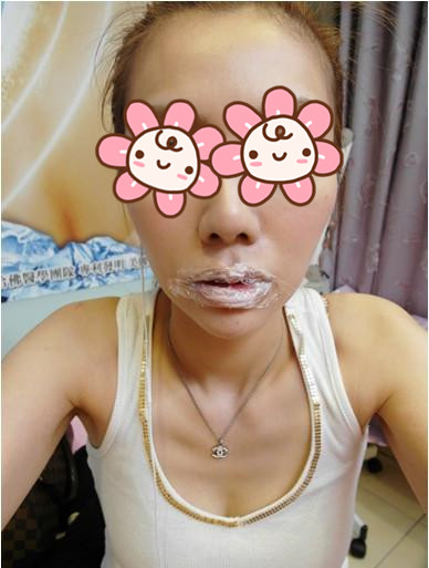 注射玻尿酸丰唇打麻药后