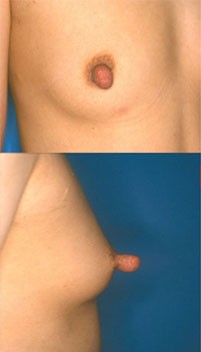 乳头缩小整形手术的案例