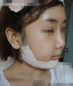 下颧骨整形的真实案例