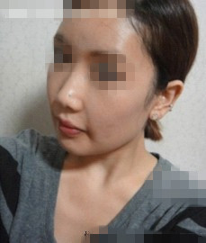 下颧骨整形的真实案例