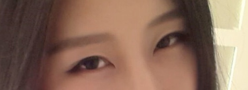 双眼皮手术