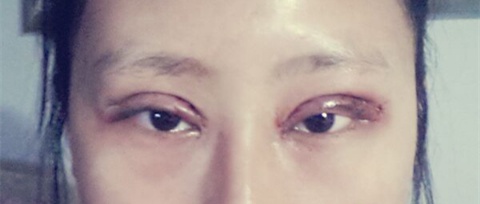 双眼皮手术