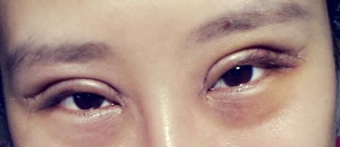 双眼皮手术