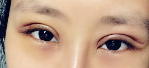 双眼皮手术