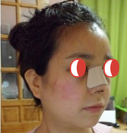 隆鼻手术