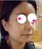 隆鼻手术