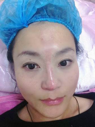 刚注射胶原蛋白隆鼻隆下巴后的样子