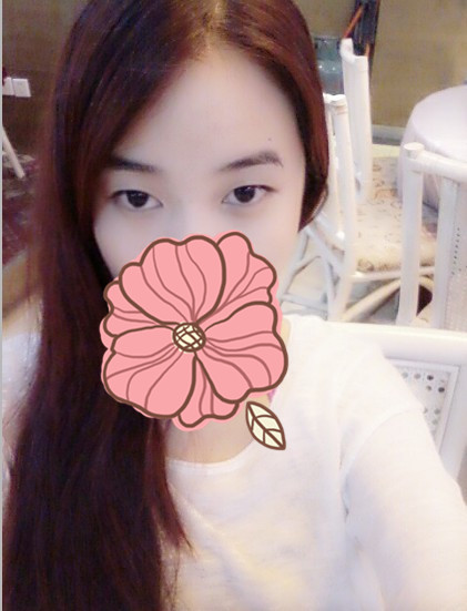 双眼皮手术的真实案例