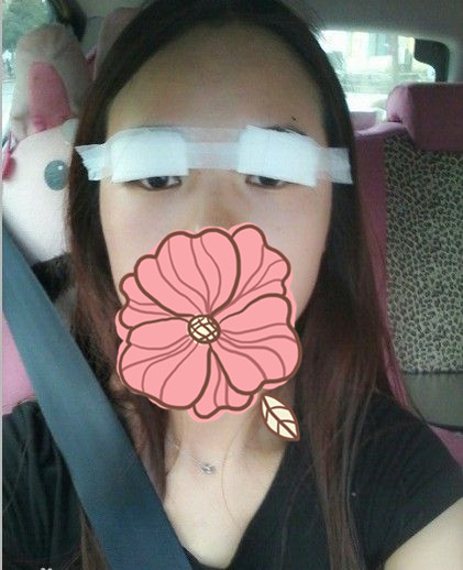 双眼皮手术的真实案例