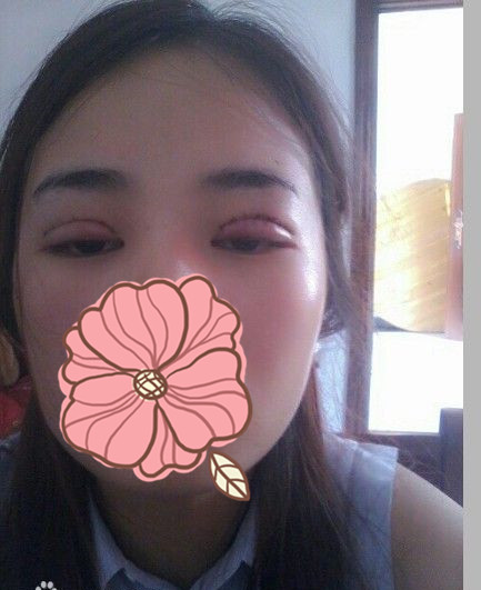 双眼皮手术的真实案例