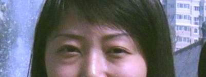 祛眼袋的真实案例