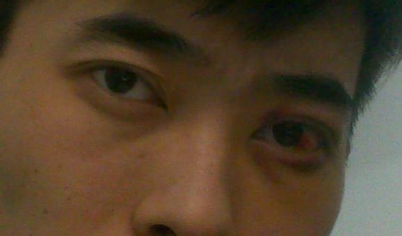 上脸下垂手术的真实案例