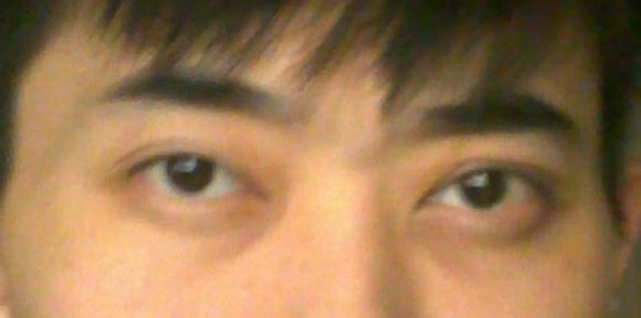 上脸下垂手术的真实案例