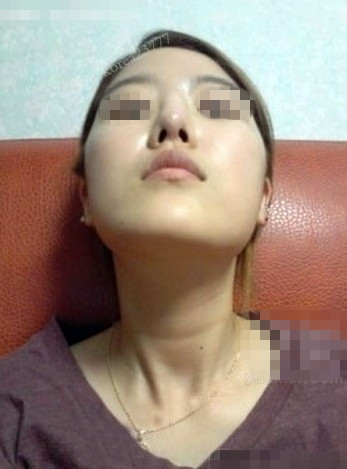 面部吸脂