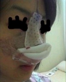 　　自体软骨移植隆鼻术