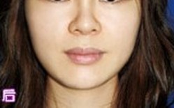 大S美白针 打造现实“白雪公主”