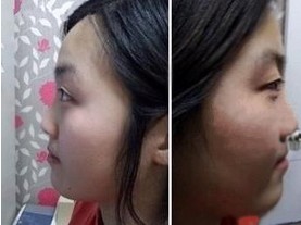 假体隆鼻的真实案例