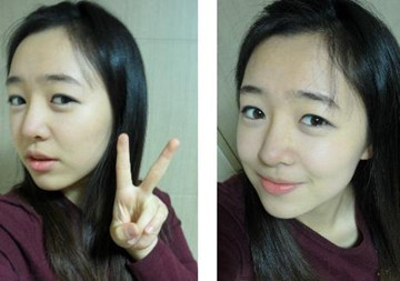 有图有真相 女子隆鼻后收获精美鼻型