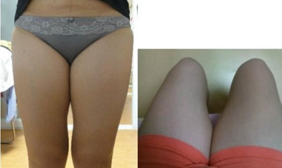 大腿吸脂手术小记