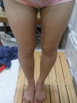 大腿吸脂手术小记