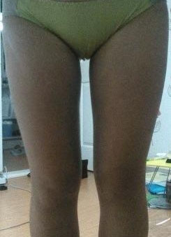 大腿吸脂手术小记