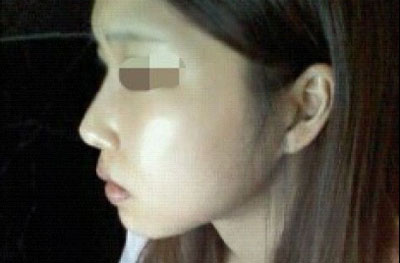 福州磨下颌角手术经验
