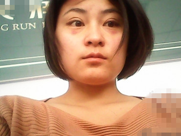 来看看 MM做双眼皮手术后的眼睛蜕变图