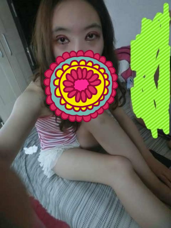 双眼皮手术的案例