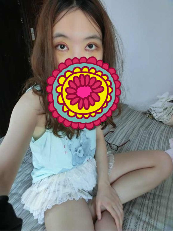 双眼皮手术的案例