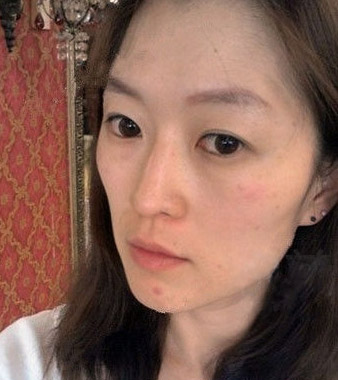 自体活力细胞年轻化真人案例分析