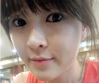自体活力细胞年轻化真人案例分析