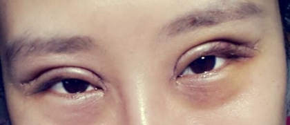 内双美女不愿再贴双眼皮贴 毅然做切开双眼皮术4