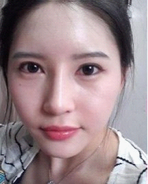 术后