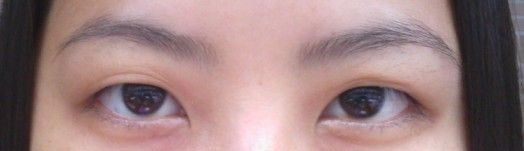 开眼睛的手术案例