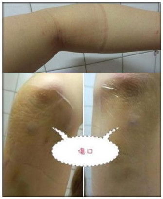 图文并茂：网友晒手臂吸脂的经历 图3