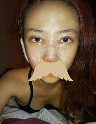 注射隆鼻的案例