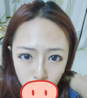注射隆鼻的案例