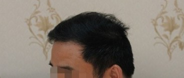 “完美”老公植发后9个月样子