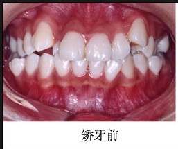 牙齿矫正