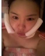 瘦脸的真实案例