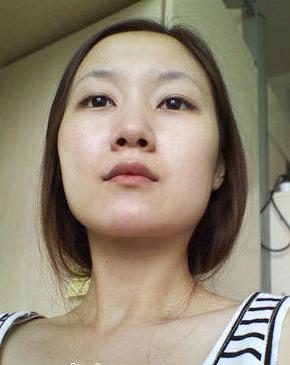 女网友颌面整形实录:瓜子脸不是梦!