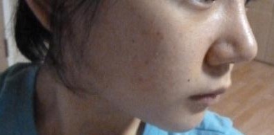 瘦脸针
