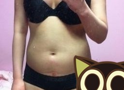 腰腹吸脂术前