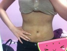 腰腹吸脂