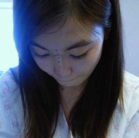 曝曝我的隆鼻手术全过程
