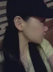 下颧骨手术