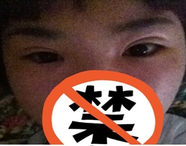 修复双眼皮之前