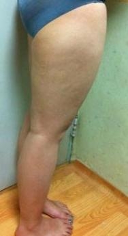 大腿吸脂手术的案例