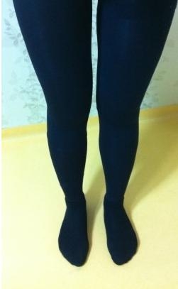 大腿吸脂手术的案例