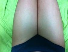 大腿吸脂手术的案例